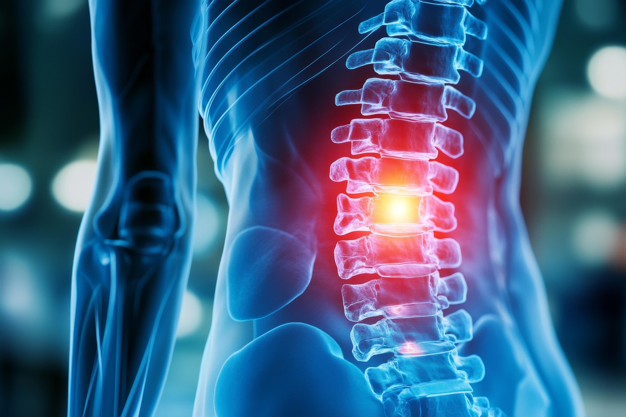 Ce este hernia de disc: cauze, simptome, transmitere și tratament